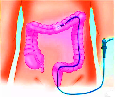 直腸癌早期有哪些癥狀?